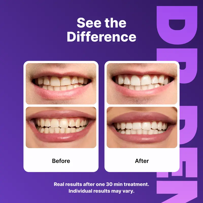 DRDENT Purple Teeth Whitening Strips - 7/21 Whitening Sessions - Non Sensitive Teeth Whitening - Peroxide-Free